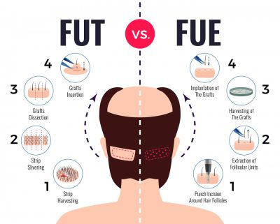 Quelles sont les différences entre les méthodes de greffe de cheveux DHI et FUE ?